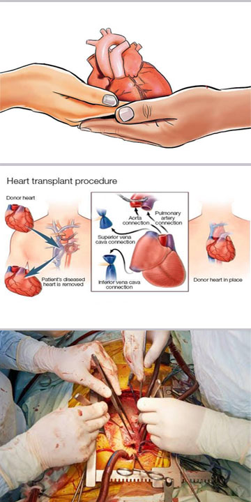 Heart Surgery